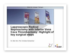 Laparoscopic radical nephrectomy with inferior vena cava thrombectomy: highlight of key surgical steps