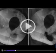 Megalourethra and urethrorectal fistula: a rare presentation and a challenging reconstruction