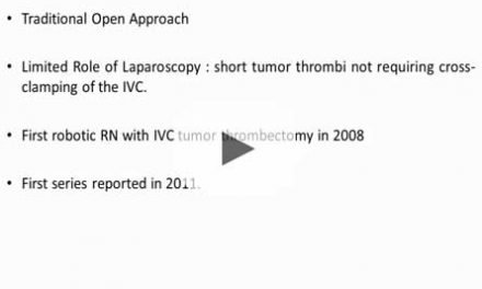 Robotic radical nephrectomy and level II inferior vena cava thrombectomy: exploring the newer frontiers