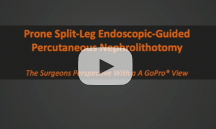 Prone split-leg endoscopic-guided percutaneous nephrolithotomy: the surgeons perspective with A Gopro® view