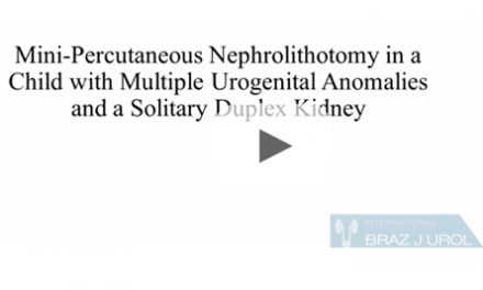Mini-percutaneous nephrolithotomy in a child with multiple urogenital anomalies and a solitary duplex kidney