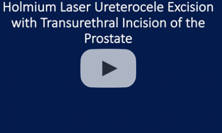 Holmium laser ureterocele excision with transurethral incision of the prostate