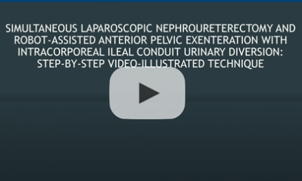 Simultaneous laparoscopic nephroureterectomy and robotassisted anterior pelvic exenteration with intracorporeal ileal conduit urinary diversion: step-by-step video-illustrated technique