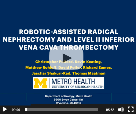 Robotic-assisted nephrectomy with level II IVC thrombectomy using Rummel Tourniquets